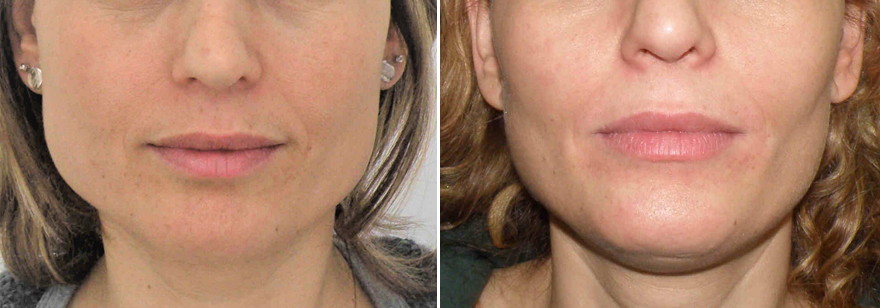 Prije-poslije ortodontske terapije