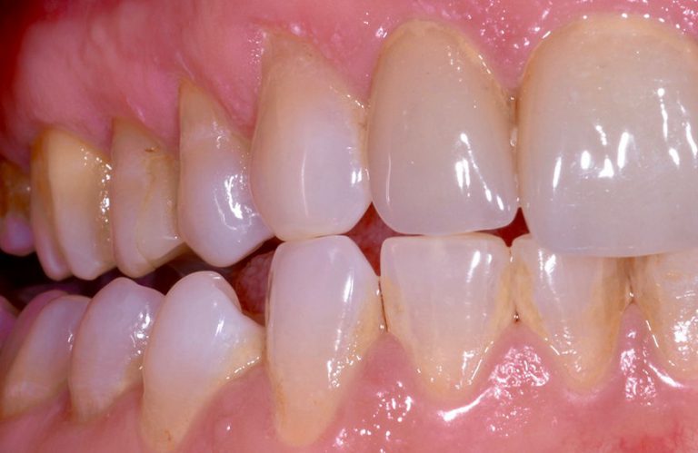 è Normale Che I Denti Si Muovono Un Pò