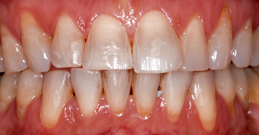 trošenje zubi-slika3